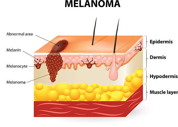 Best Melanoma Illustrations, Royalty.