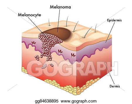 melanoma clip art 10 free Cliparts | Download images on Clipground 2024