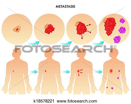 Clipart of metastasis k18578221.
