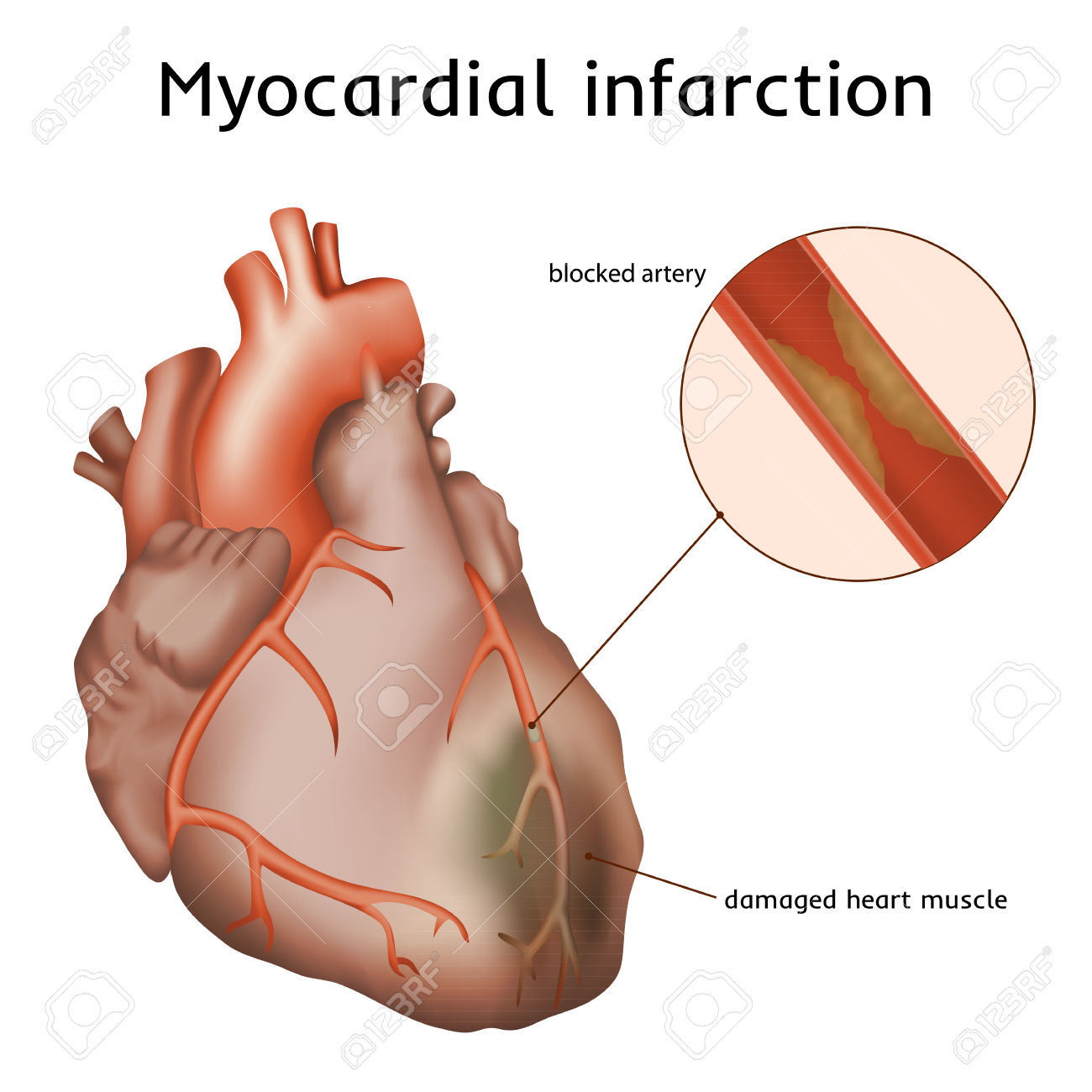 Myocardial Infarction. Heart Attack. Blocked Artery, Damaged.