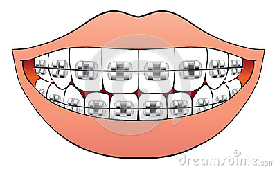 Orthodontist Braces Clipart.