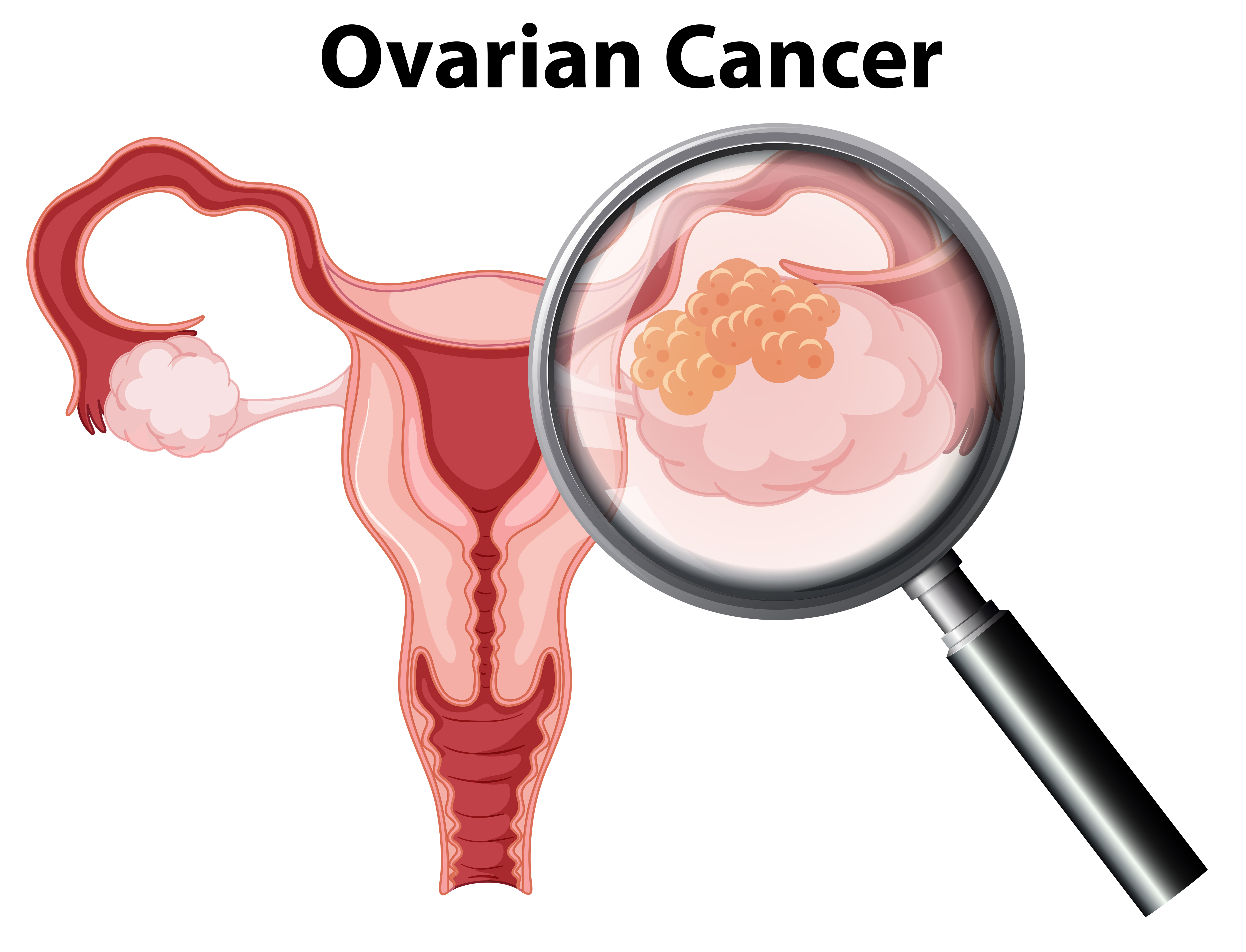 Ovarian Cancer Free Vector Art.