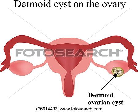 Clipart of Dermoid cyst on the ovary. Ovary. Infographics. Vector.