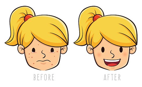 Girl Face With Acne Problem Before and After premium clipart.
