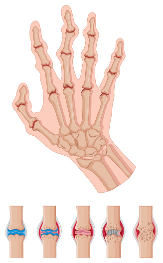 Rheumatism clipart 20 free Cliparts | Download images on Clipground 2024