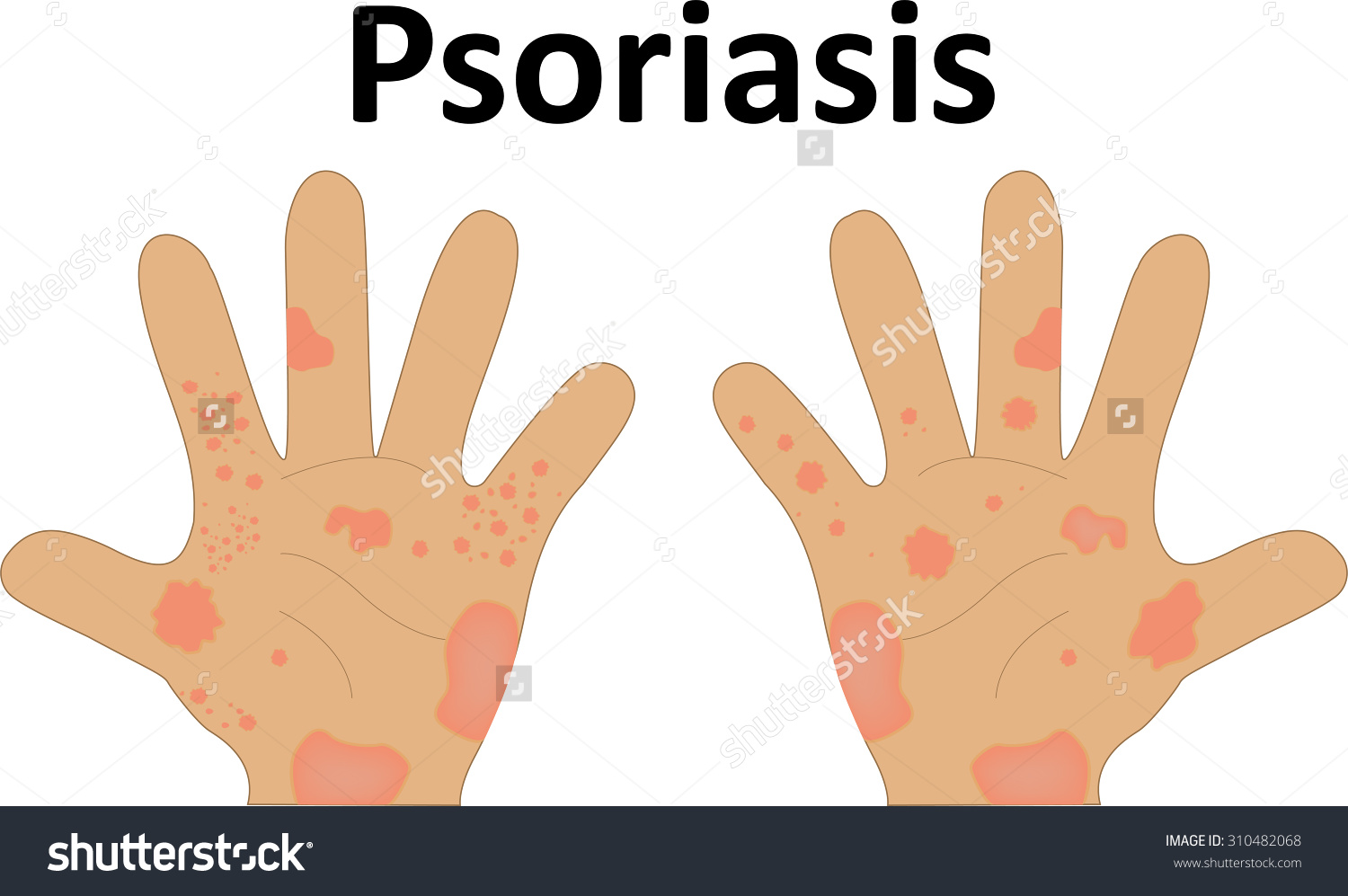 Psoriasis Clip Art.