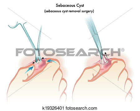 Cyst clip art.