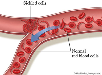 SICKLE CELL TRAIT - 71px Image #7