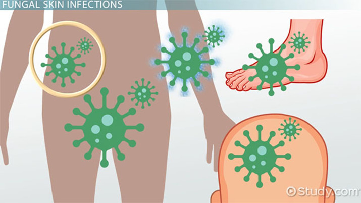 Bacteria clipart fungal infection, Bacteria fungal infection.