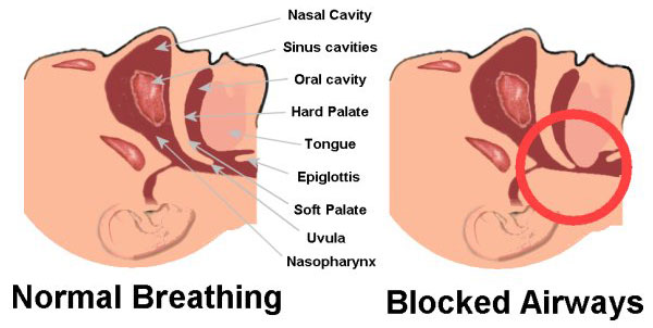 Sleep Apnea Treatment.