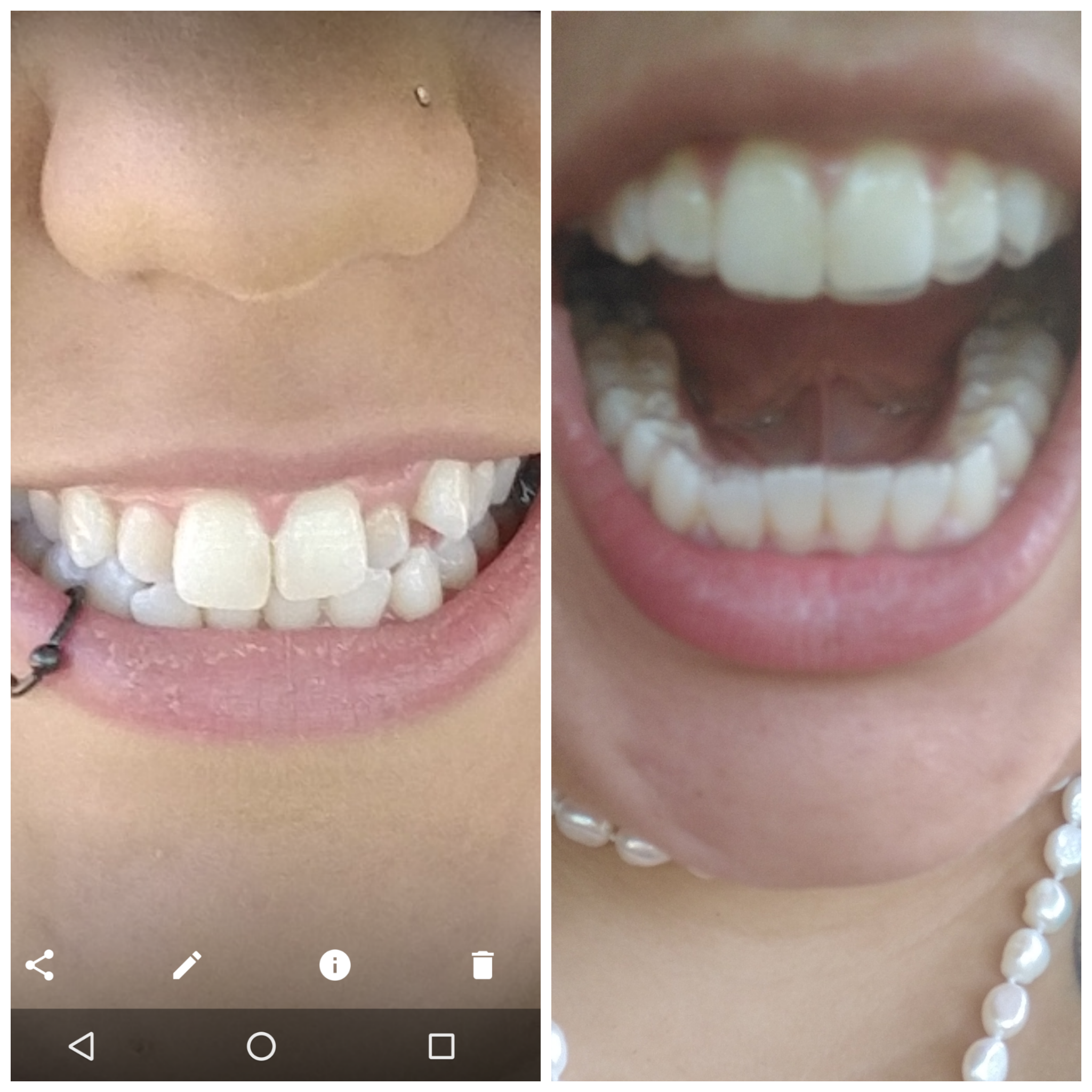 Before and almost after/w aligners in : smiledirectclub.