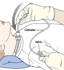 When Your Child Needs a Tracheostomy: Suctioning.
