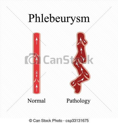Vectors Illustration of Phlebeurysm. Varicose veins. Venous.