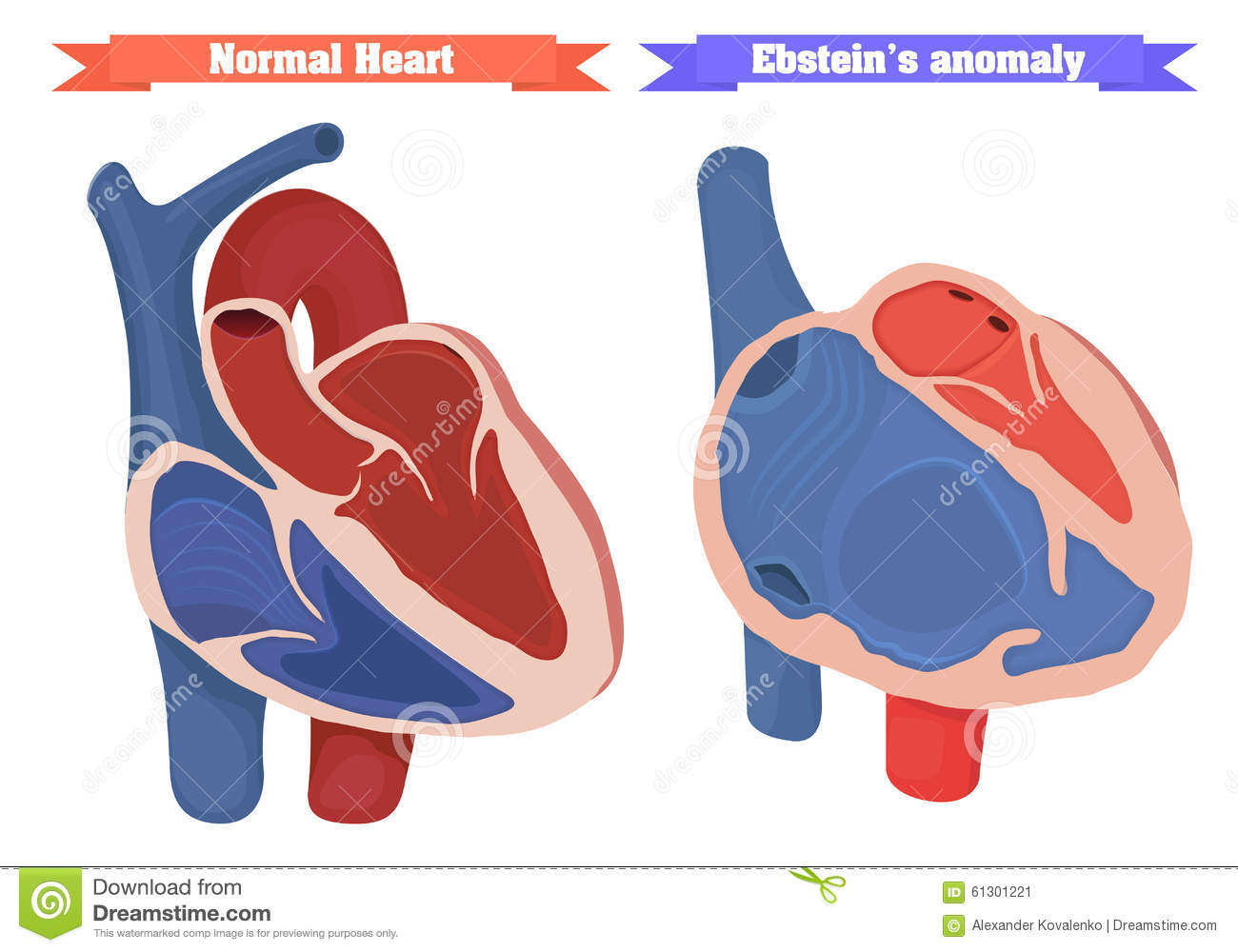 Ebstein Anomaly Versus Normal Heart Structure Vector Illustration.