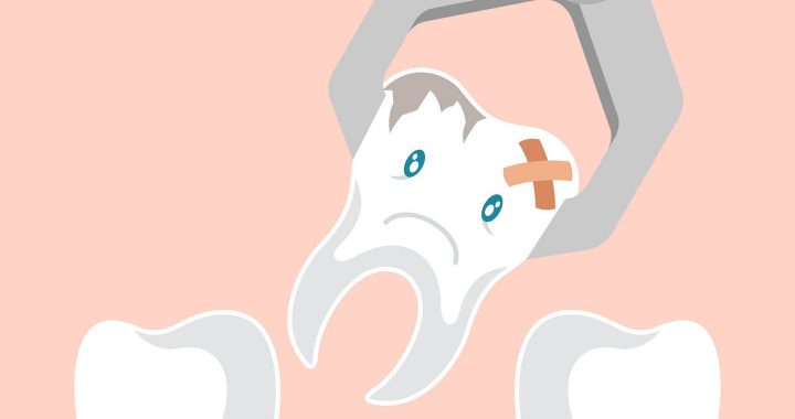Wisdom Teeth Removal : Benefits of Having Tooth Extraction.